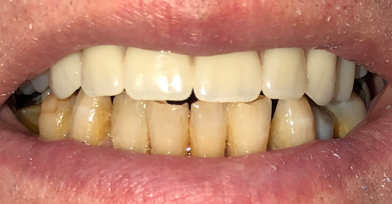 Patient 5 Dental Implants AFTER