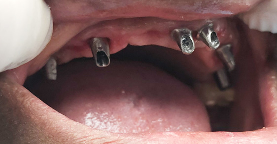 Patient 6 Dental Implants BEFORE