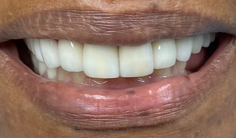 Smile Makeover in NYC after