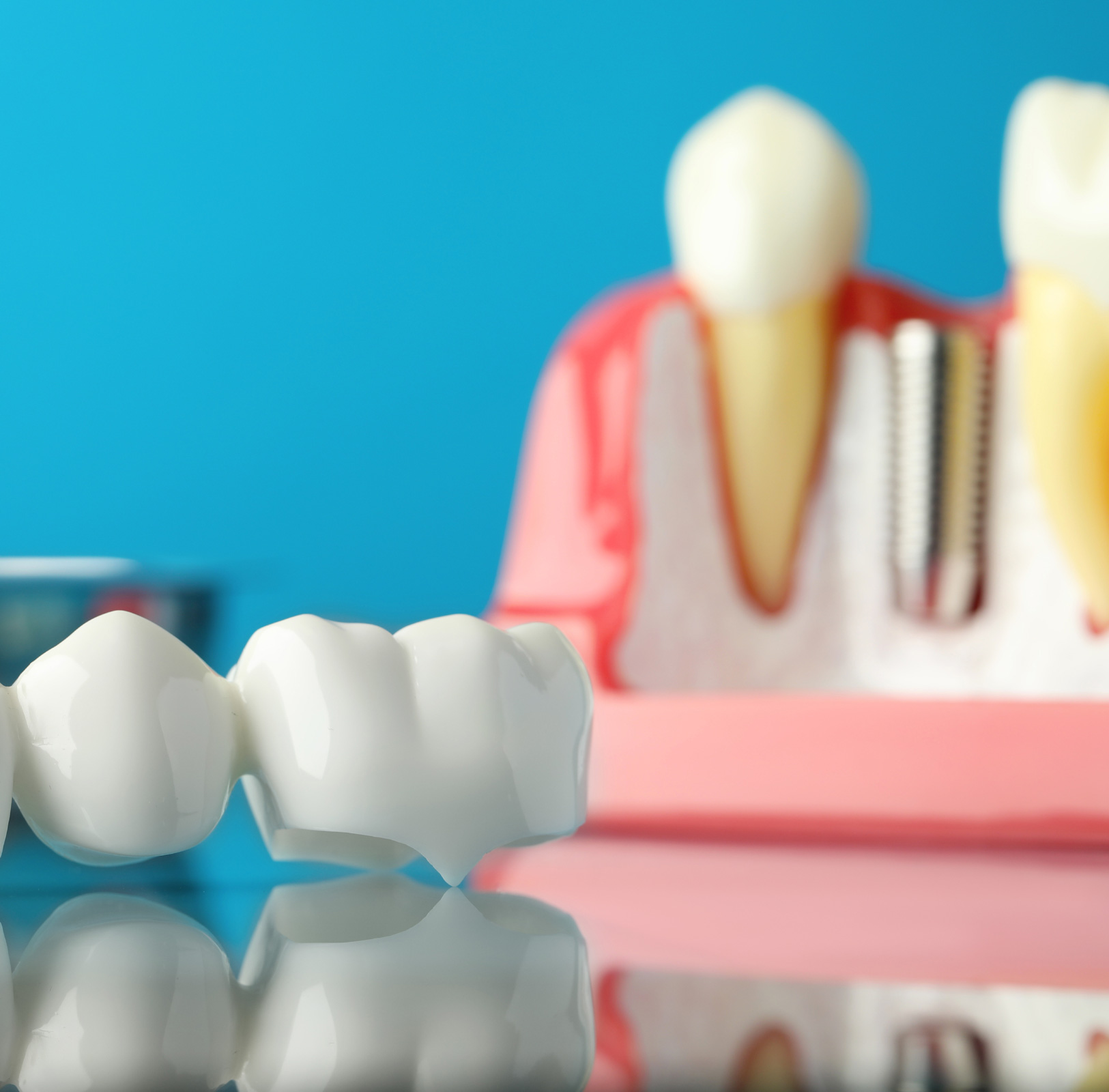 Dental bridge near educational model of gum with implant