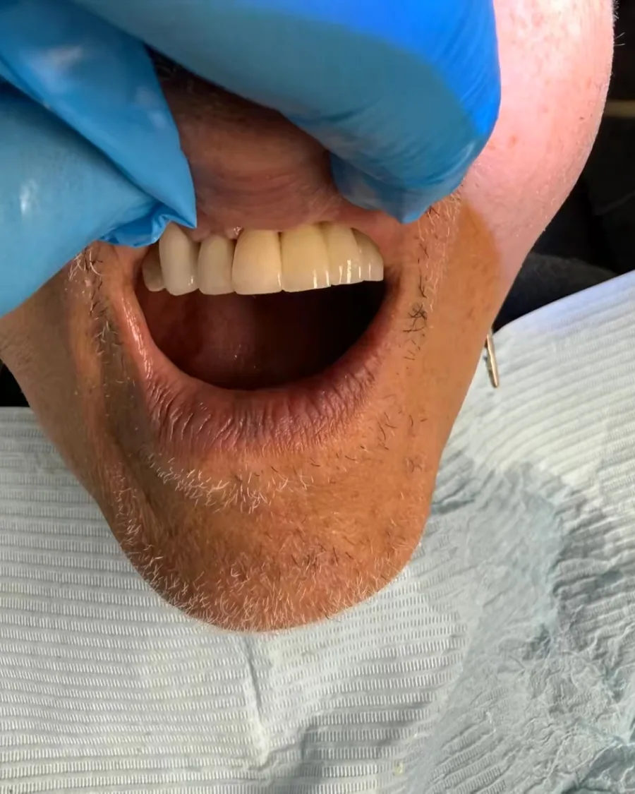 Dental Implant — after treatment