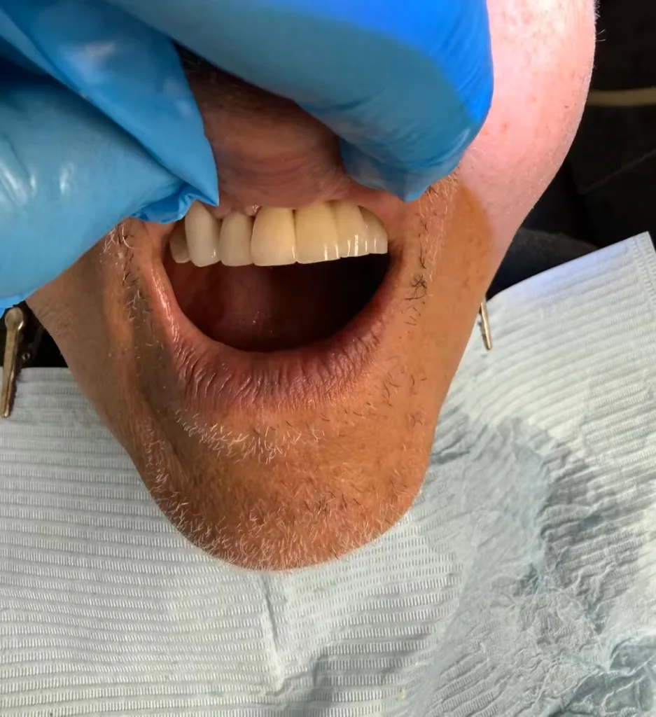 Dental Implant — after treatment