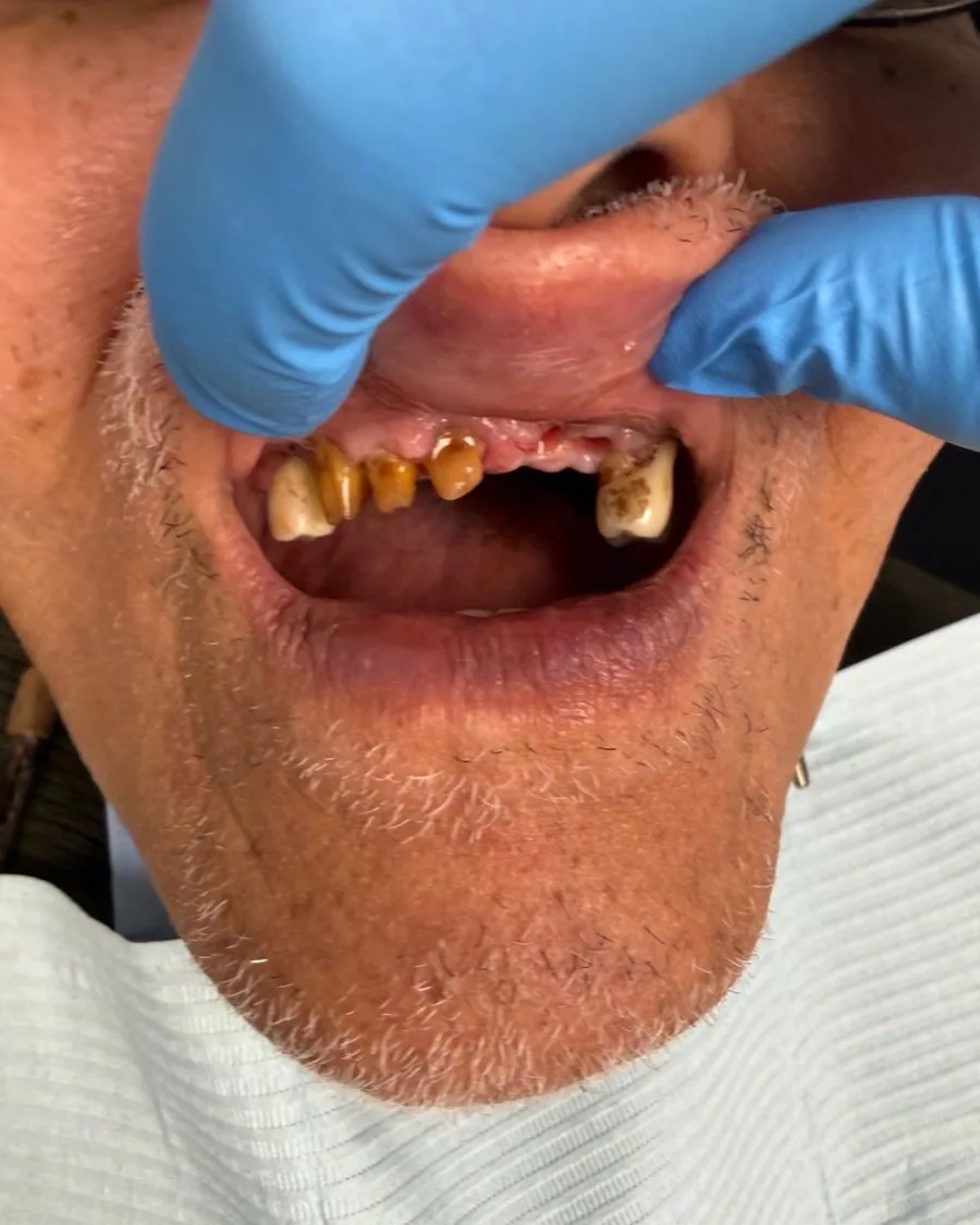 Dental Implant — before treatment