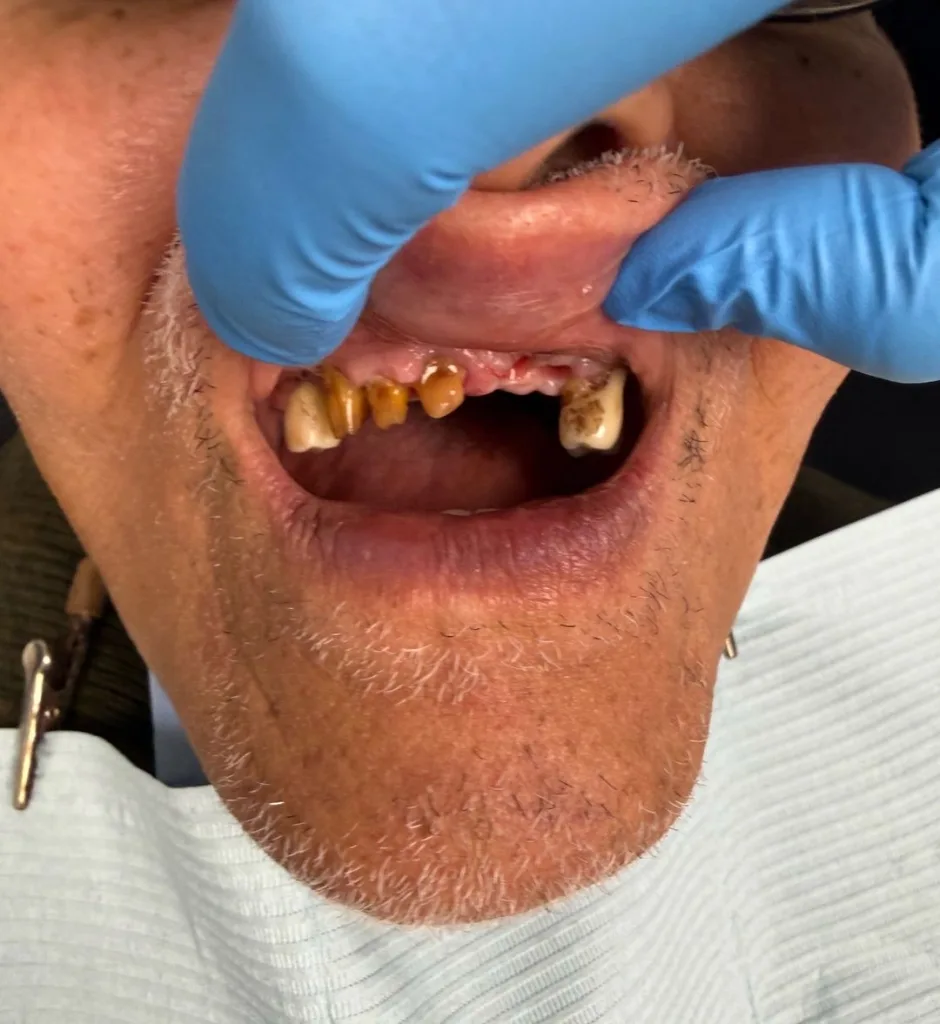 Dental Implant — before treatment