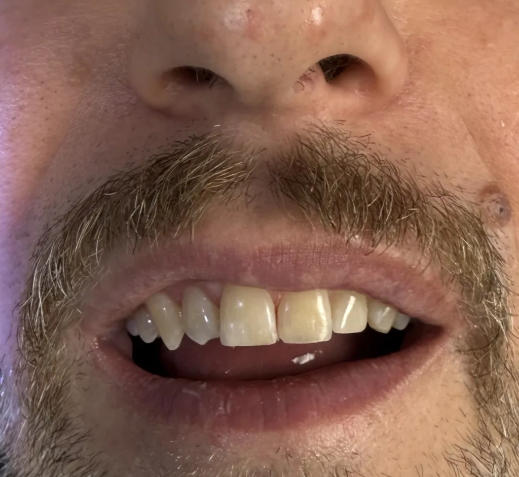 Porcelain Veneers — after treatment