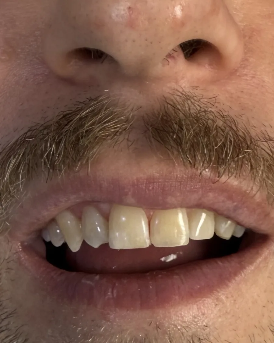 Porcelain Veneers — after treatment