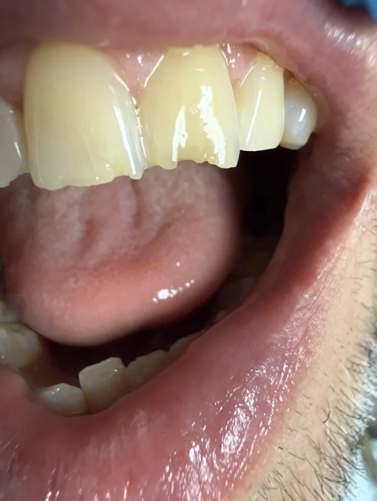 Porcelain Veneers — before treatment