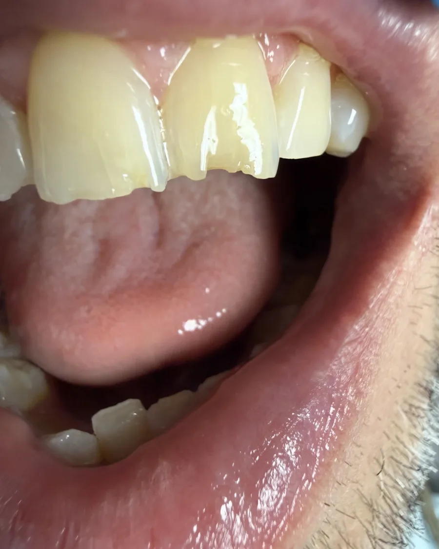 Porcelain Veneers — before treatment