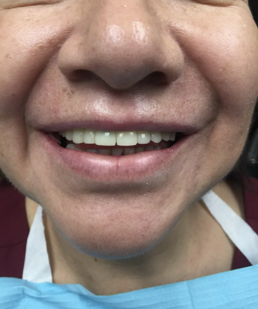 Smile Makeover — after treatment