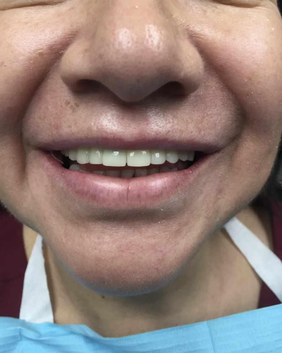 Smile Makeover — after treatment