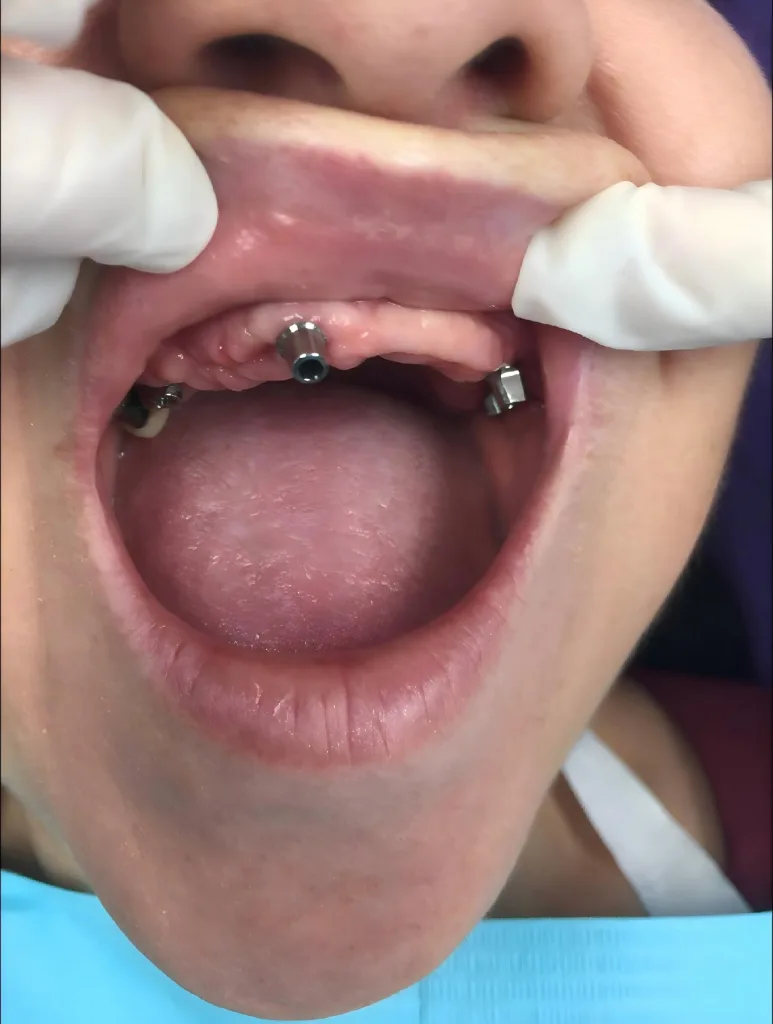 Smile Makeover — before treatment