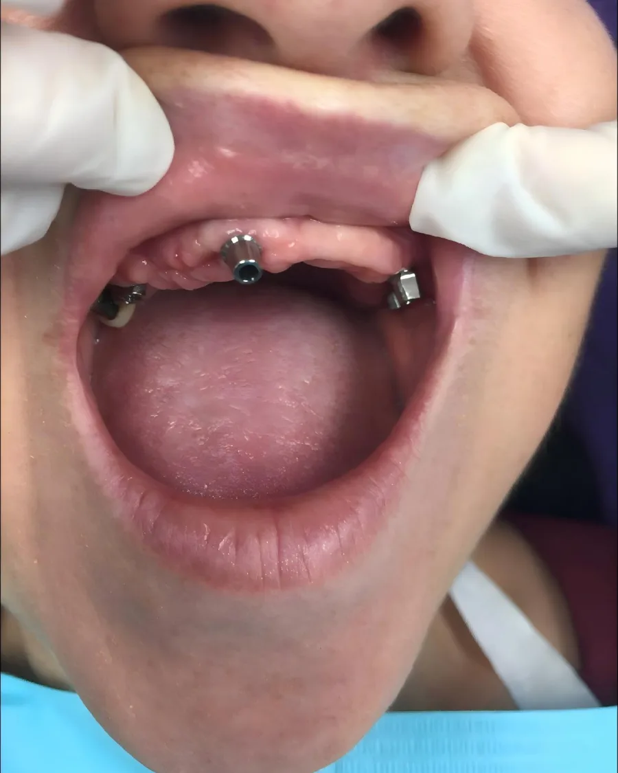 Smile Makeover — before treatment
