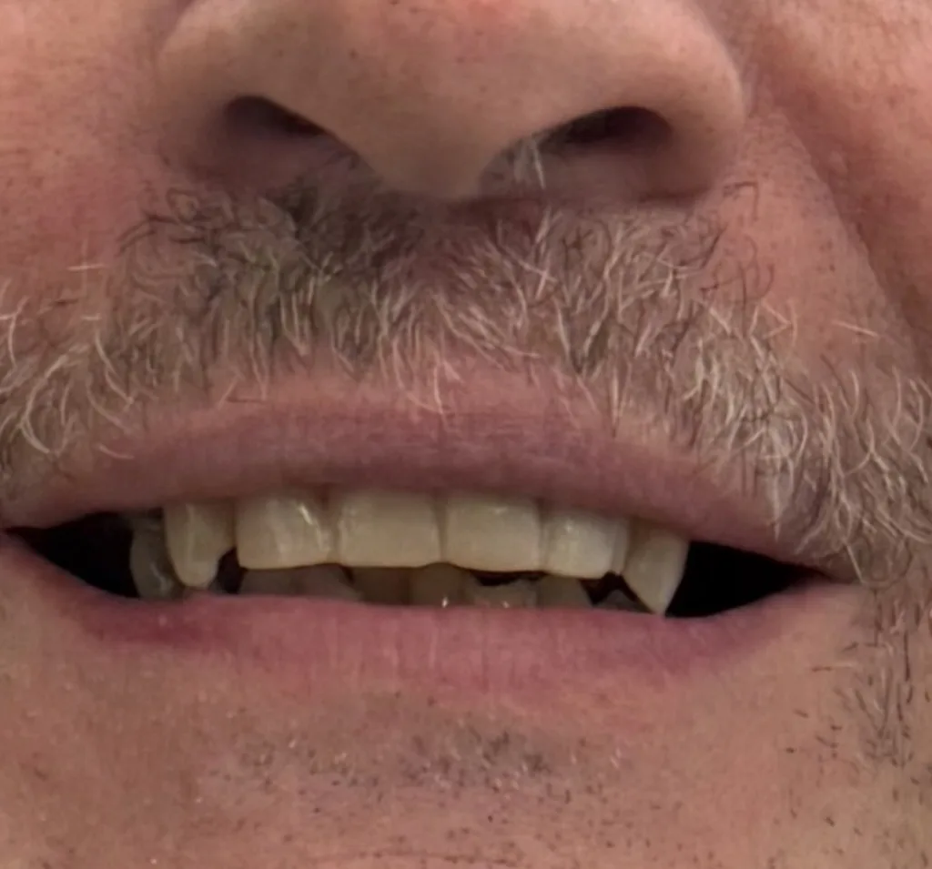 Teeth Whitening — after treatment