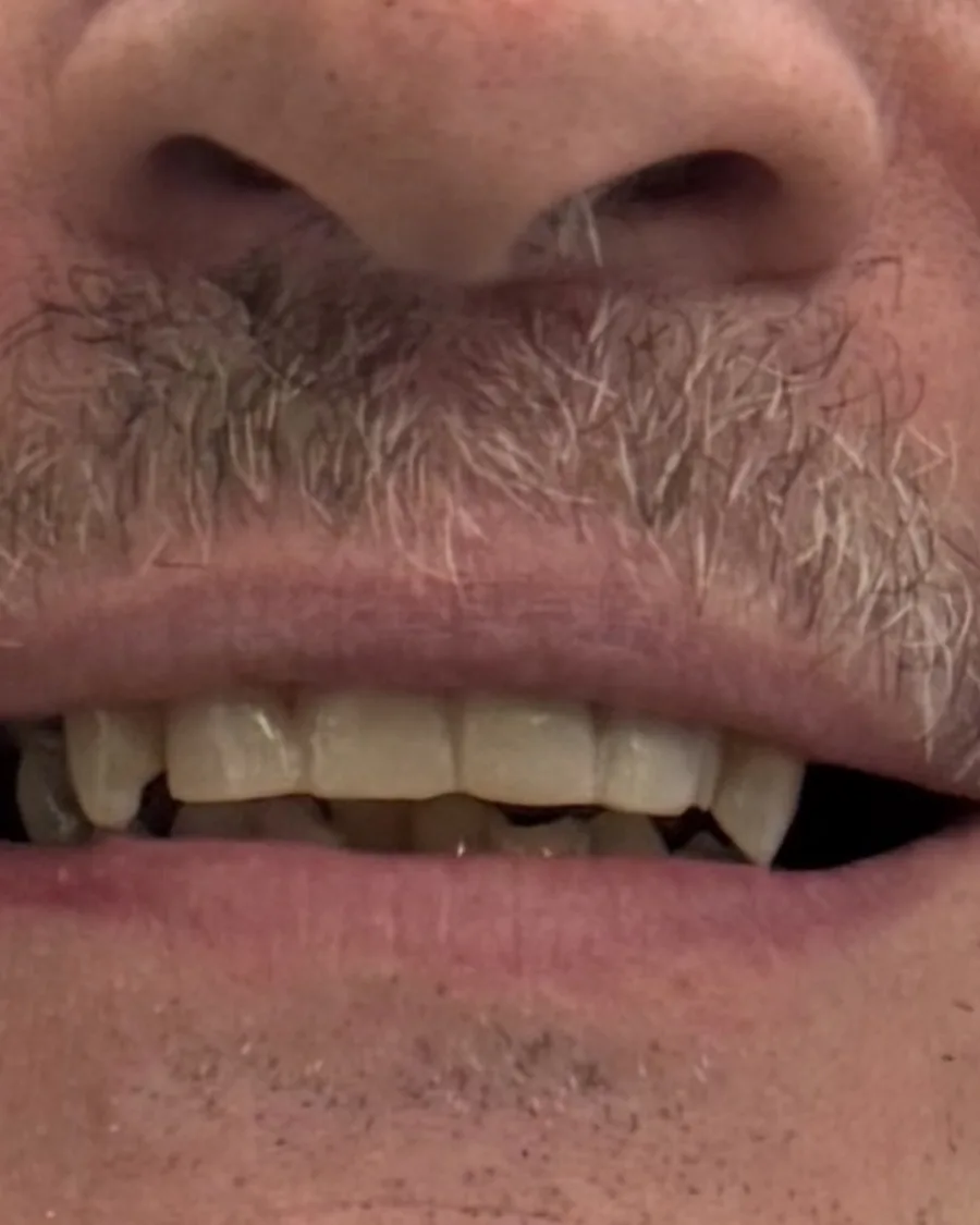 Teeth Whitening — after treatment