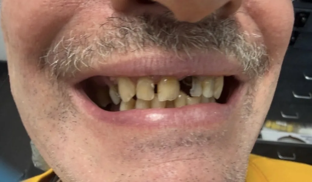 Teeth Whitening — before treatment