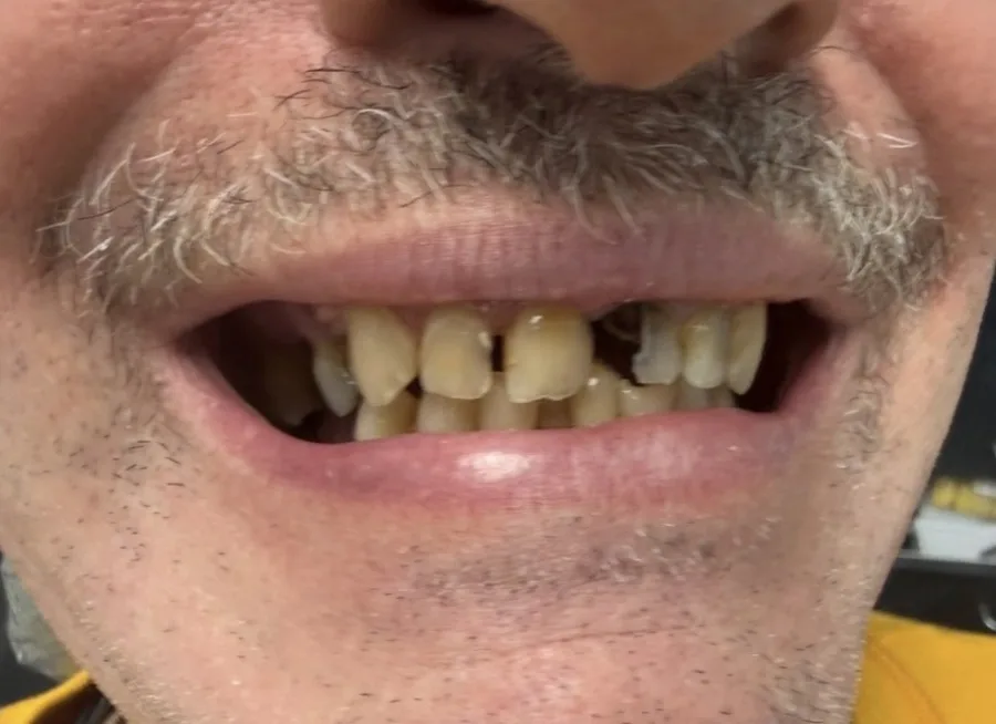 Teeth Whitening — before treatment