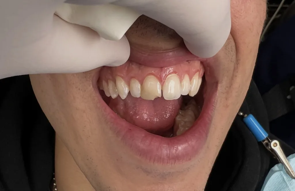 Porcelain Veneers — before treatment