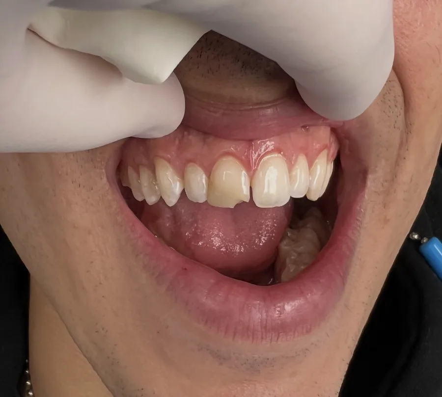 Porcelain Veneers — before treatment