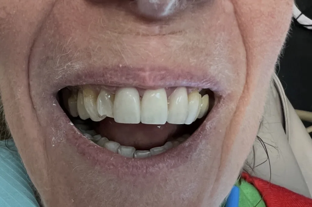 Porcelain Veneers — before treatment