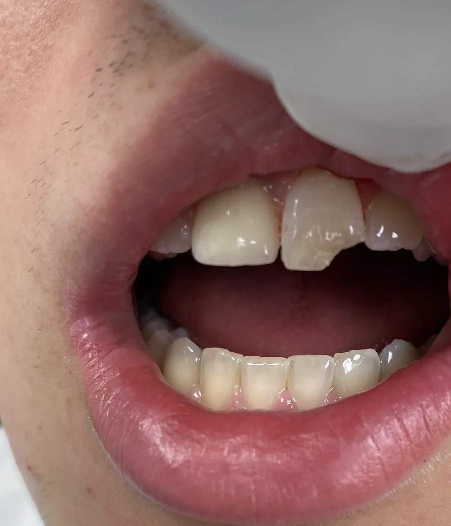 Porcelain Veneers — before treatment