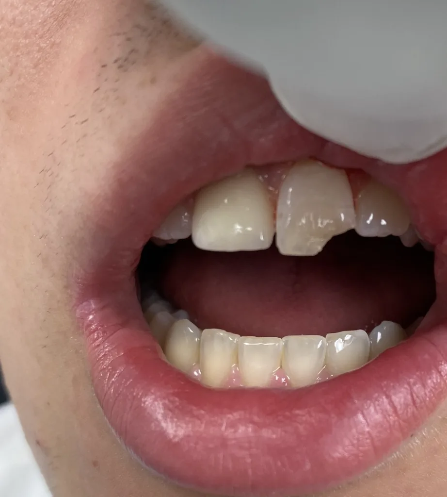 Porcelain Veneers — before treatment