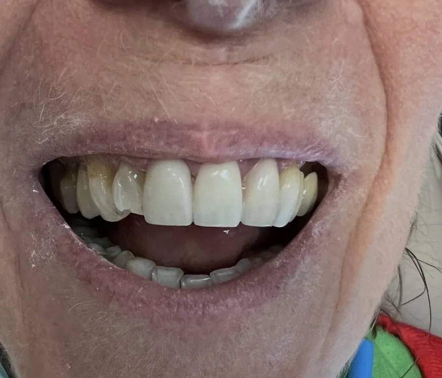 Porcelain Veneers — before treatment