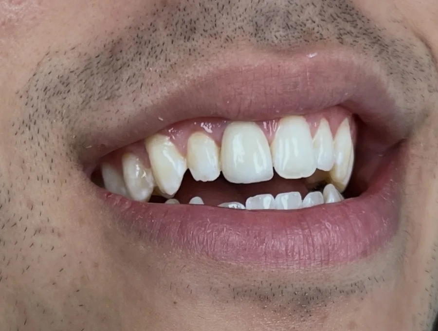 Porcelain Veneers — after treatment