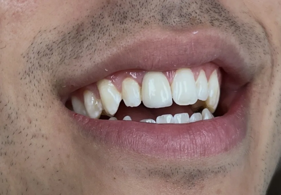 Porcelain Veneers — after treatment