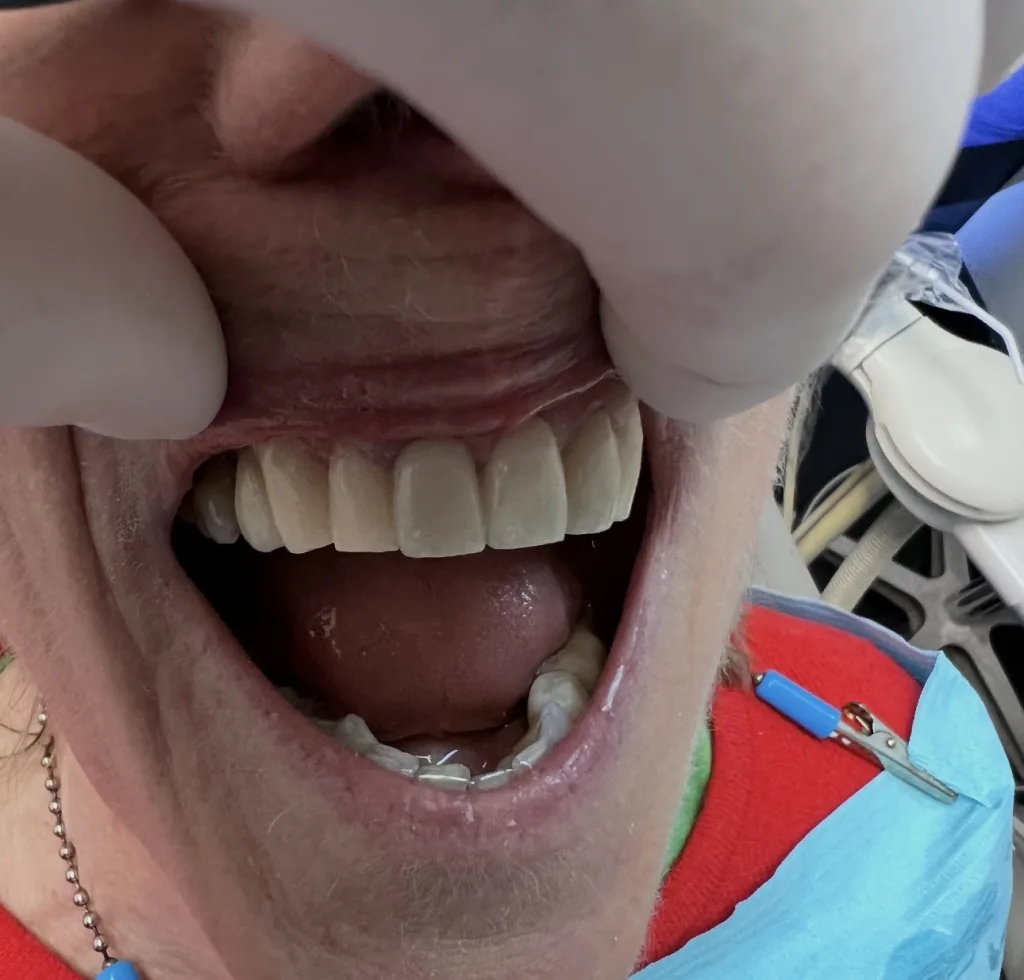 Porcelain Veneers — after treatment