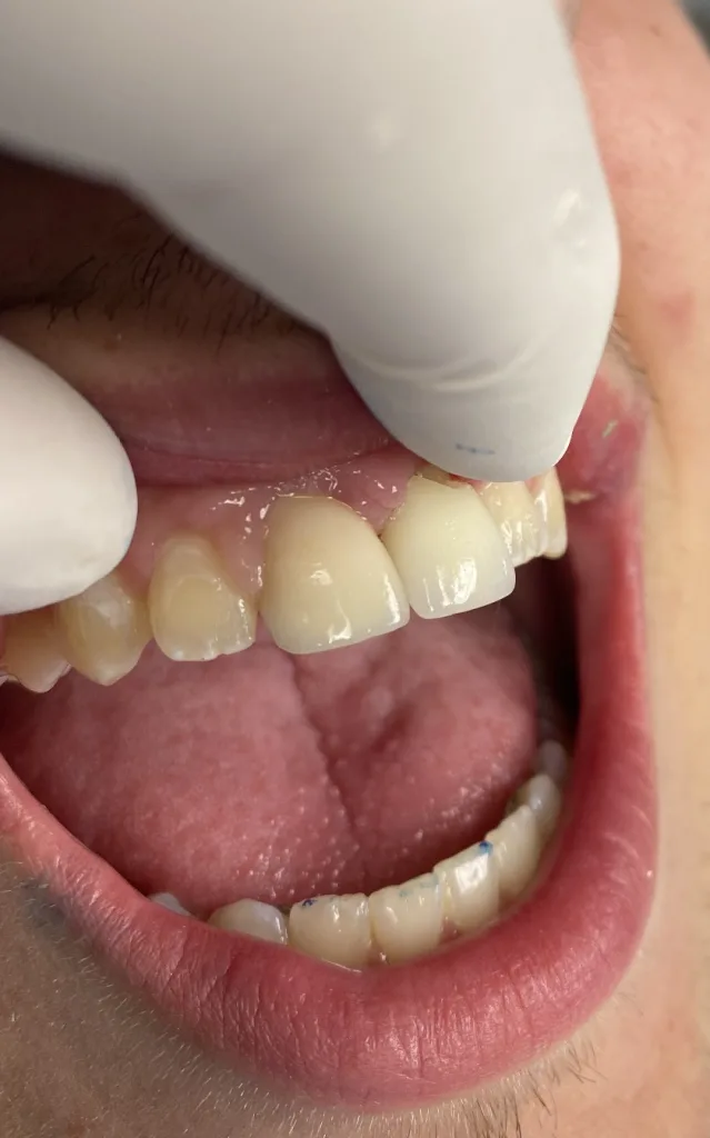 Porcelain Veneers — after treatment