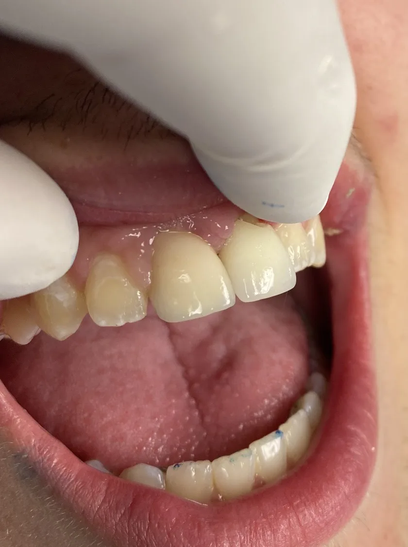 Porcelain Veneers — after treatment