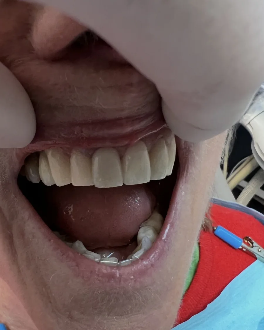 Porcelain Veneers — after treatment